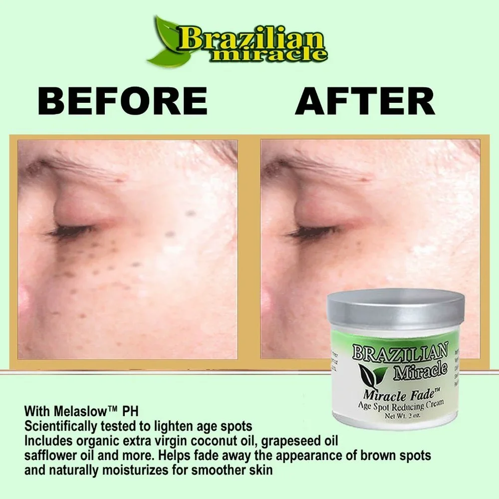 Anti Melasma Cream‎ Dark Spots Age Spots Freckles